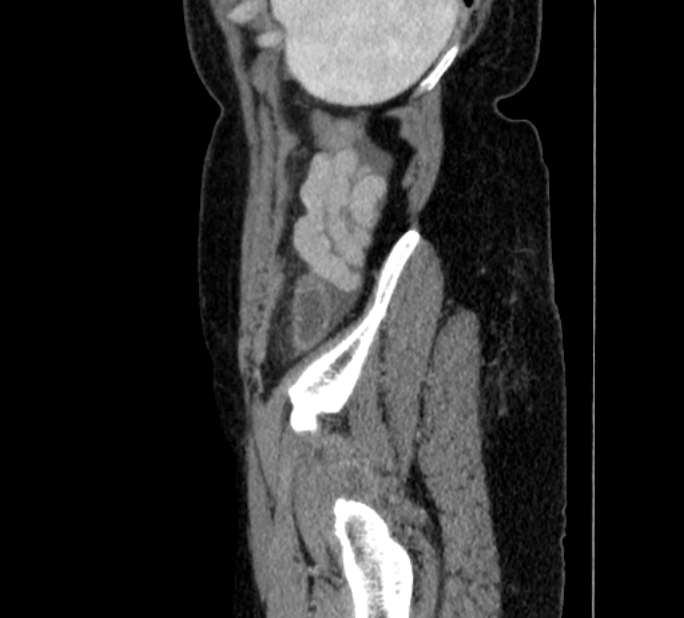 Closed loop small bowel obstruction (Radiopaedia 71211-81508 C 154).jpg