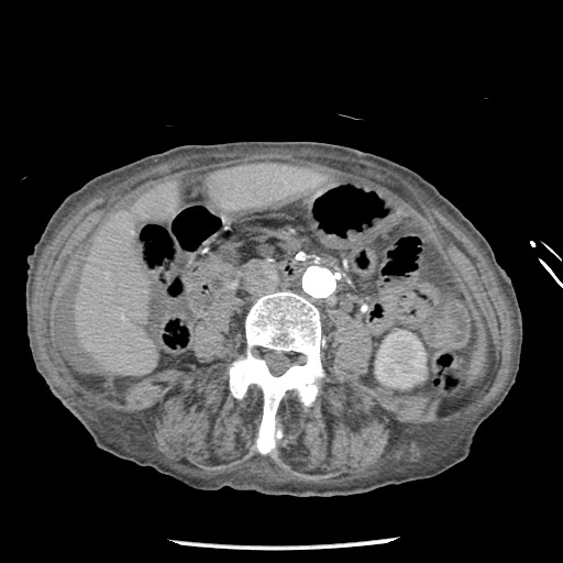 Closed loop small bowel obstruction - adhesions and infarct (Radiopaedia 85125-100678 A 89).jpg