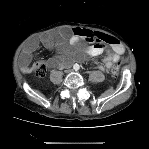 Closed loop small bowel obstruction - adhesive disease and hemorrhagic ischemia (Radiopaedia 86831-102990 A 122).jpg