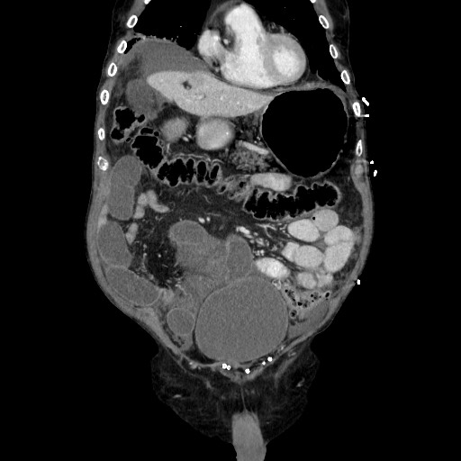 Closed loop small bowel obstruction - adhesive disease and hemorrhagic ischemia (Radiopaedia 86831-102990 B 44).jpg