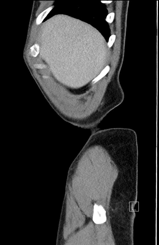 Closed loop small bowel obstruction - internal hernia (Radiopaedia 57806-64778 C 104).jpg
