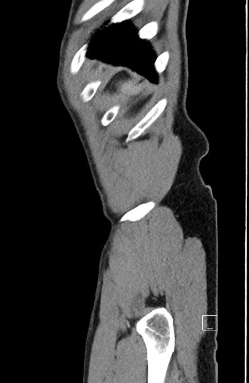 Closed loop small bowel obstruction - internal hernia (Radiopaedia 57806-64778 C 12).jpg