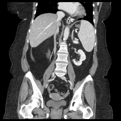 Closed loop small bowel obstruction - internal hernia (Radiopaedia 65402-74450 B 65).jpg
