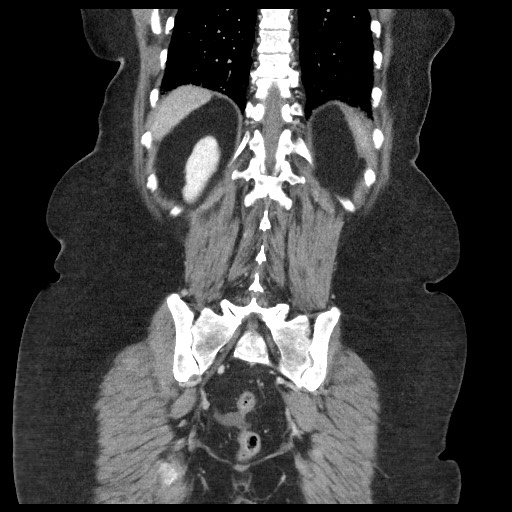 Closed loop small bowel obstruction - internal hernia (Radiopaedia 65402-74450 B 86).jpg