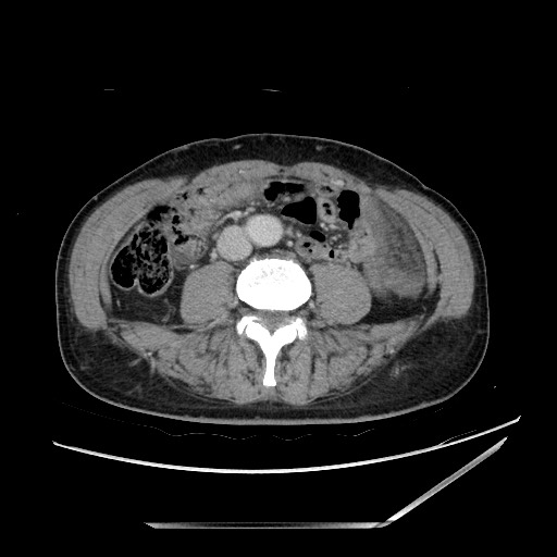 File:Closed loop small bowel obstruction - omental adhesion causing "internal hernia" (Radiopaedia 85129-100682 Axial 1).jpg