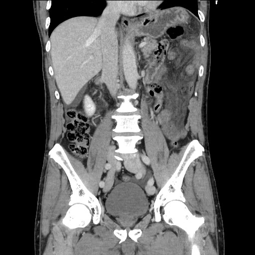 Closed loop small bowel obstruction - omental adhesion causing "internal hernia" (Radiopaedia 85129-100682 B 69).jpg