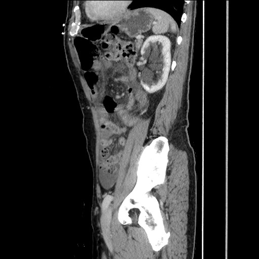 File:Closed loop small bowel obstruction - omental adhesion causing "internal hernia" (Radiopaedia 85129-100682 C 128).jpg