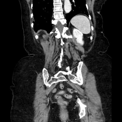 Closed loop small bowel obstruction due to adhesive band, with intramural hemorrhage and ischemia (Radiopaedia 83831-99017 C 97).jpg