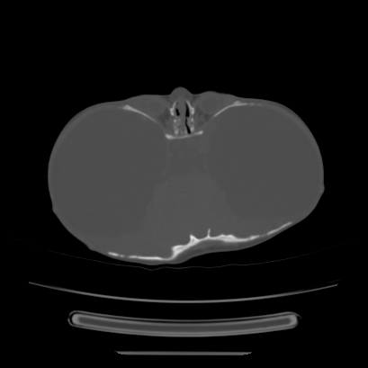 Cloverleaf skull (Radiopaedia 91901-109710 Axial bone window 69).jpg