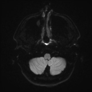 File:Cochlear incomplete partition type III associated with hypothalamic hamartoma (Radiopaedia 88756-105498 Axial DWI 45).jpg