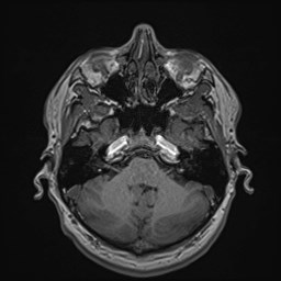File:Cochlear incomplete partition type III associated with hypothalamic hamartoma (Radiopaedia 88756-105498 Axial T1 58).jpg