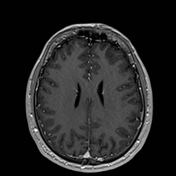 Cochlear incomplete partition type III associated with hypothalamic hamartoma (Radiopaedia 88756-105498 Axial T1 C+ 128).jpg