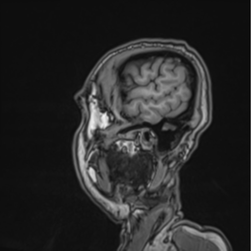 File:Colloid cyst of the third ventricle (Radiopaedia 86571-102662 Sagittal T1 69).png