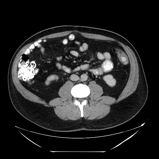 Colocolic intussusception due to lipoma (Radiopaedia 73712-84508 A 64).jpg