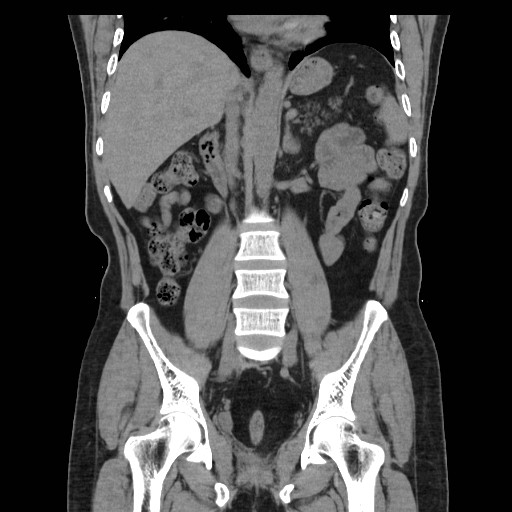 File:Colocutaneous fistula in Crohn's disease (Radiopaedia 29586-30093 Coronal non-contrast 21).jpg