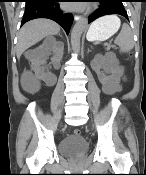 Colon adenocarcinoma - splenic flexure (Radiopaedia 34143-35406 B 43).png