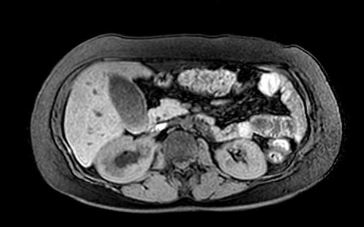 Colon adenocarcinoma with Krukenberg tumors, advanced pregnancy (Radiopaedia 67279-76645 A 54).jpg