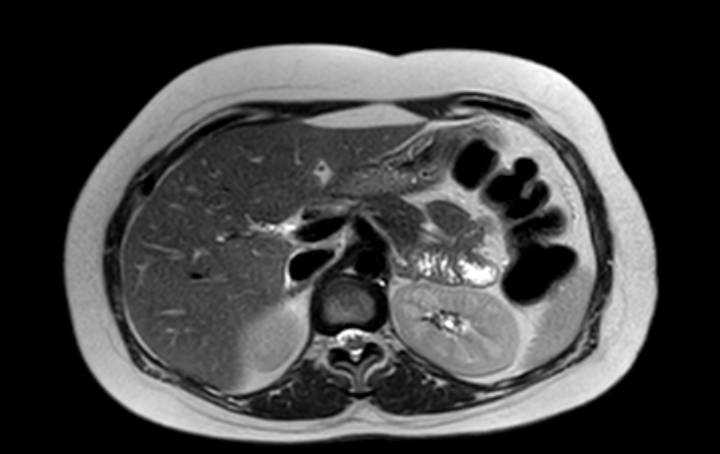 Colon adenocarcinoma with Krukenberg tumors, advanced pregnancy (Radiopaedia 67279-76645 Axial T2 61).jpg