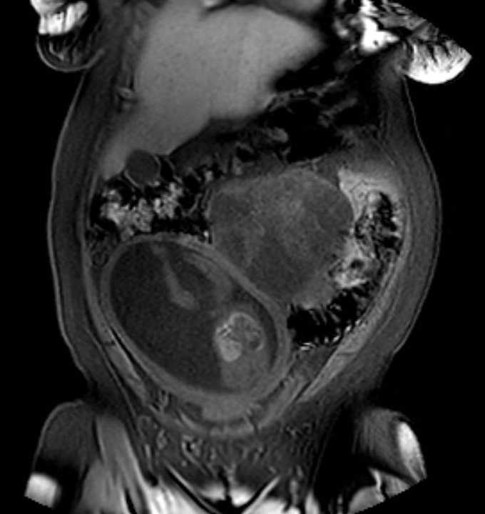 Colon adenocarcinoma with Krukenberg tumors, advanced pregnancy (Radiopaedia 67279-76645 E 18).jpg