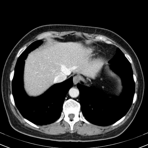 Colon carcinoma with hepatic metastases (Radiopaedia 29477-29961 A 13).jpg