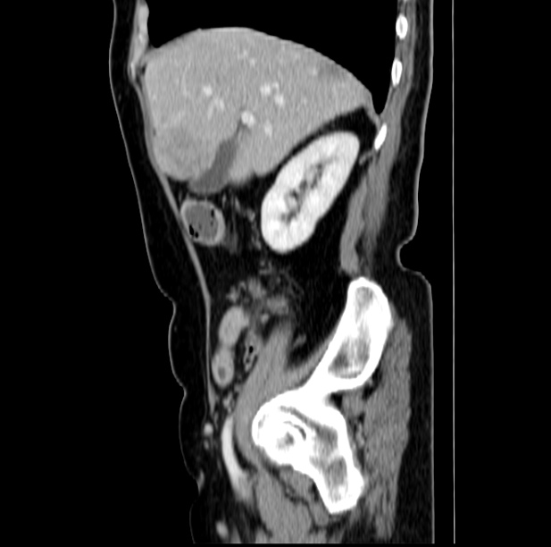 Colon carcinoma with hepatic metastases (Radiopaedia 29477-29961 C 16).jpg