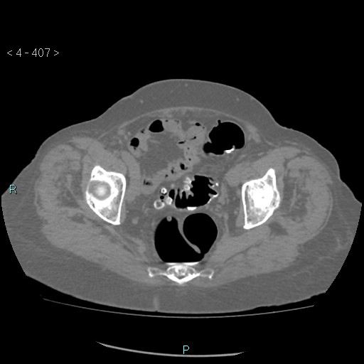 File:Colonic lipomas (Radiopaedia 49137-54244 Axial bone window 181).jpg