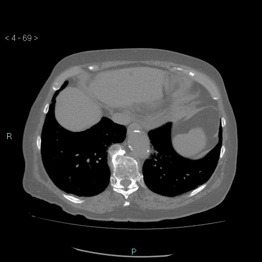 File:Colonic lipomas (Radiopaedia 49137-54244 Axial bone window 31).jpg
