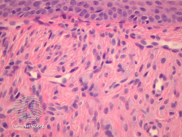 File:Figure 3 (DermNet NZ pathology-e-angiofibroma-figure-3).jpg
