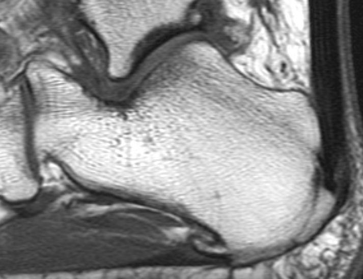 File:Haglund deformity and calcaneal spurs (MRI) (Radiopaedia 16654).jpg