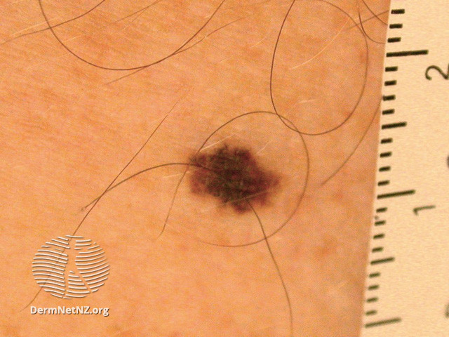 File:Lentigo simplex (DermNet NZ lesions-lentigo-simplex1).jpg