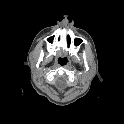 File:Nasal pyogenic granuloma (lobular capillary hemangioma) (Radiopaedia 85536-101244 C 6).jpg