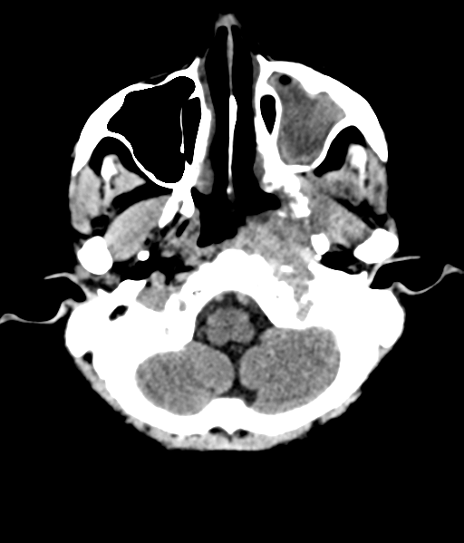 File:Nasopharyngeal carcinoma with cerebral abscess (Radiopaedia 43018-46275 Axial non-contrast 10).png