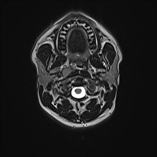 Nasopharyngeal carcinoma with perineural spread (Radiopaedia 55030-61380 Axial T2 34).jpg