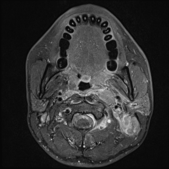File:Nasopharyngeal carcinoma with skull base invasion (Radiopaedia 53415-59485 Axial T1 C+ fat sat 38).jpg