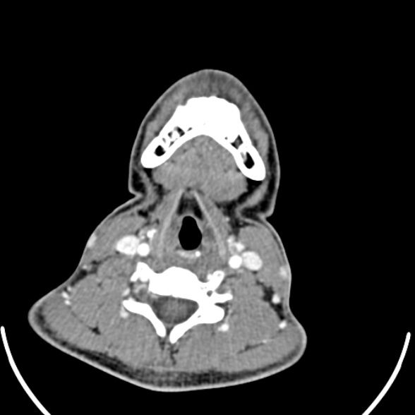 File:Nasopharyngeal carcinoma with skull base invasion (Radiopaedia 53415-59705 A 144).jpg