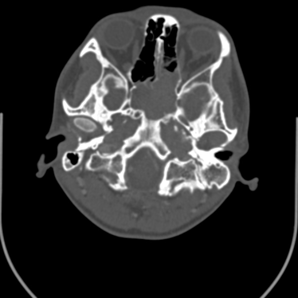 Nasopharyngeal carcinoma with skull base invasion (Radiopaedia 53415-59705 Axial bone window 24).jpg