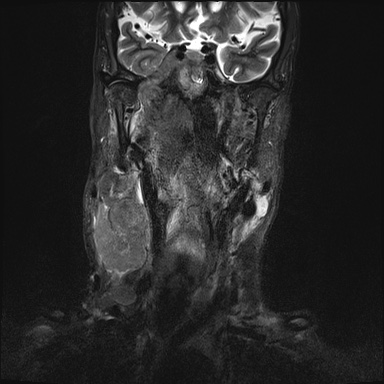 Nasopharyngeal carcinoma with skull base invasion (Radiopaedia 59258-66600 Coronal T2 fat sat 18).jpg