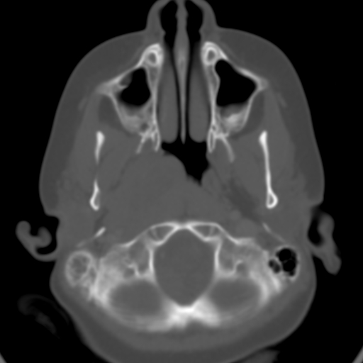 File:Nasopharyngeal rhabdomyosarcoma (Radiopaedia 23417-23491 Axial bone window 5).jpg
