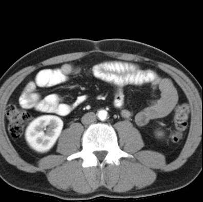 File:Necrotizing pancreatitis with acute necrotic collection (Radiopaedia 14470-14417 B 30).jpg
