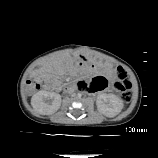 File:Neonatal neuroblastoma (Radiopaedia 56651-63438 Axial non-contrast 47).jpg