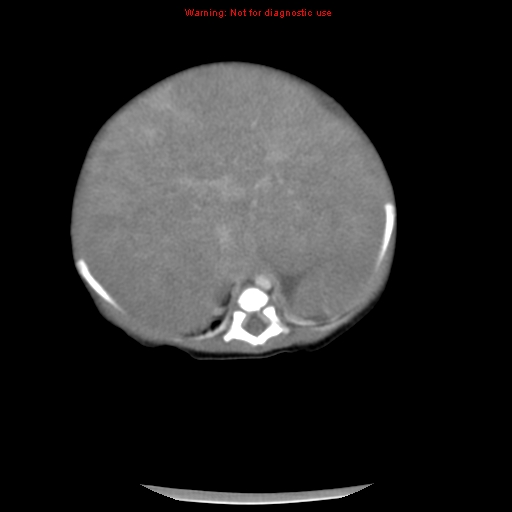 File:Neonatal neuroblastoma (Radiopaedia 9564-10223 A 17).jpg