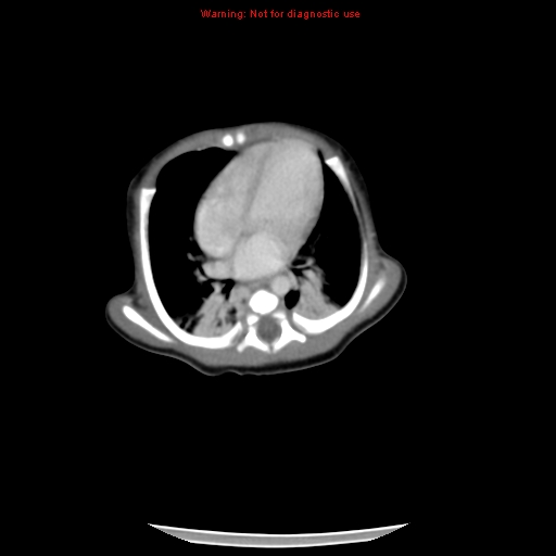 File:Neonatal neuroblastoma (Radiopaedia 9564-10223 A 9).jpg