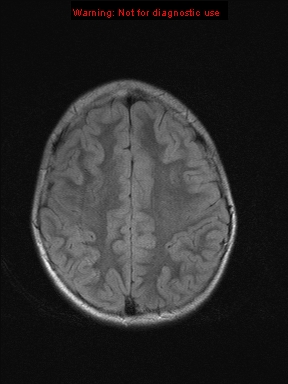 File:Neurofibromatosis type 1 with optic nerve glioma (Radiopaedia 16288-15965 Axial FLAIR 7).jpg