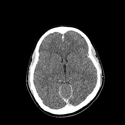 File:Neurofibromatosis type 2 (Radiopaedia 25389-25637 Axial C+ 45).jpg
