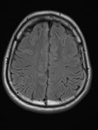 File:Neurofibromatosis type 2 (Radiopaedia 44936-48838 Axial FLAIR 18).png