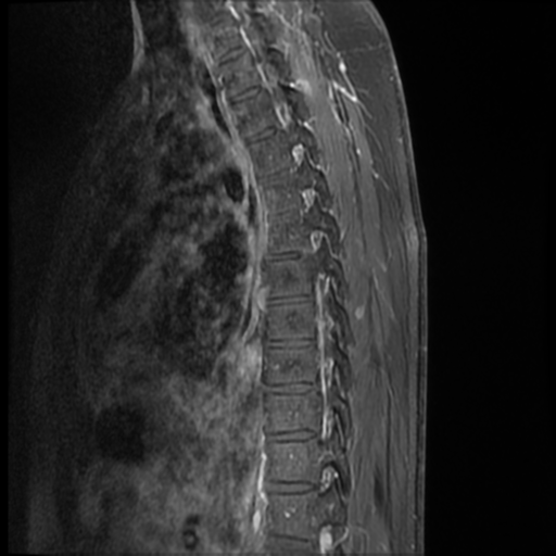 File:Neurofibromatosis type 2 (spinal manifestations) (Radiopaedia 53943-60070 I 5).png