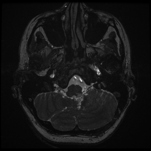 Neurofibromatosis type 2 - bilateral acoustic neuromata (Radiopaedia 40060-42566 Axial FIESTA 15).png