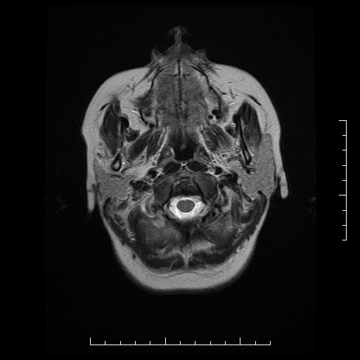File:Neuroglial cyst of brainstem (Radiopaedia 29134-29526 Axial T2 1).jpg