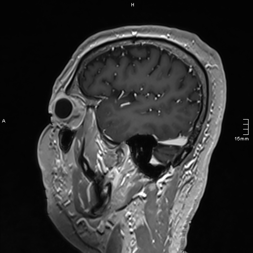 Neurosarcoidosis - involvement of the mesial temporal lobes (Radiopaedia 67429-76820 Sagittal T1 C+ 38).jpg
