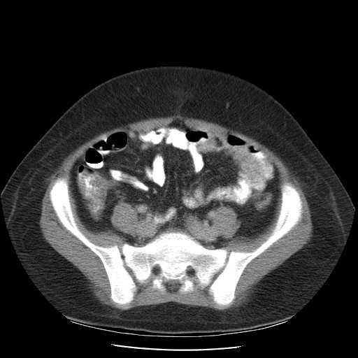 File:Non-Hodgkin lymphoma involving pelvis (Radiopaedia 21281-21197 A 46).jpg